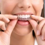 Aligners