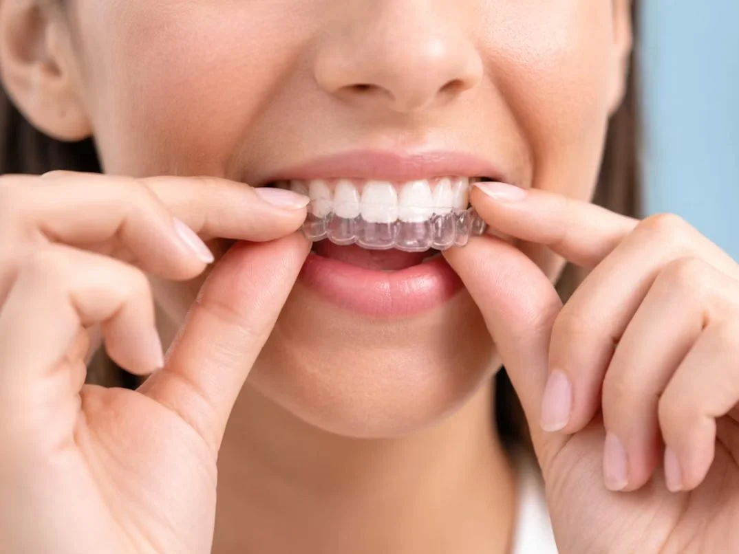 Aligners